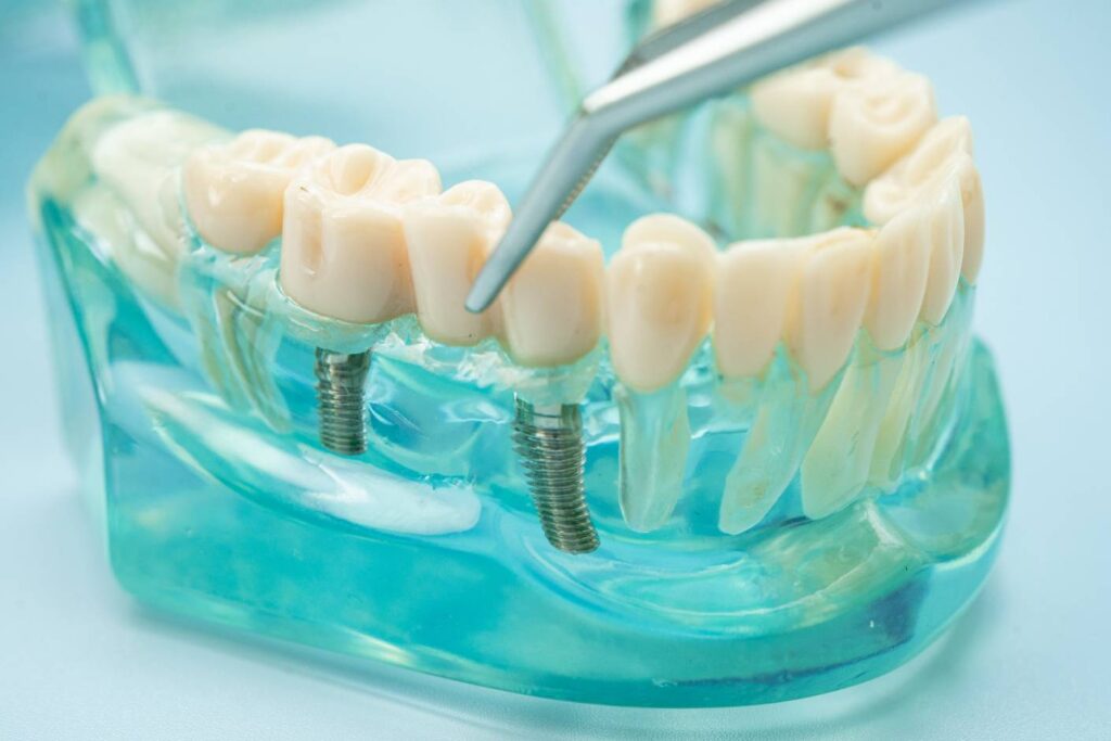 Dental implant model with tweezers for crown place 2026 01 08 22 52 27 utc bij Trail Verwijskliniek